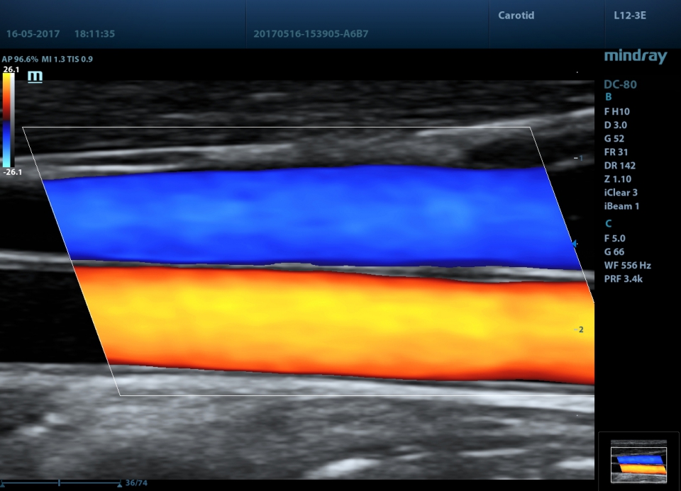 Mindray DC-80 X-Insight